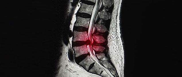 herniated disc chiropractor in La Verne, CA