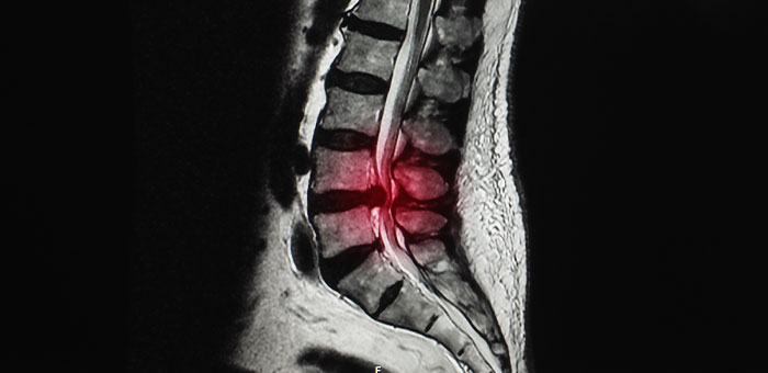 patient needing herniated disc treatment in La Verne