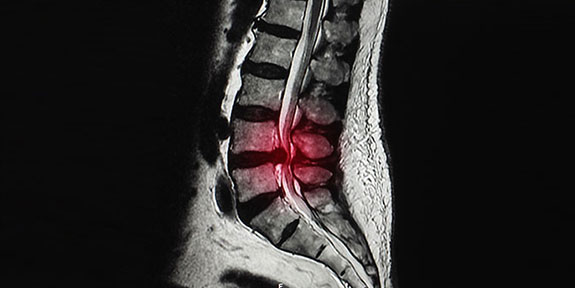disc injury Treatment in La Verne