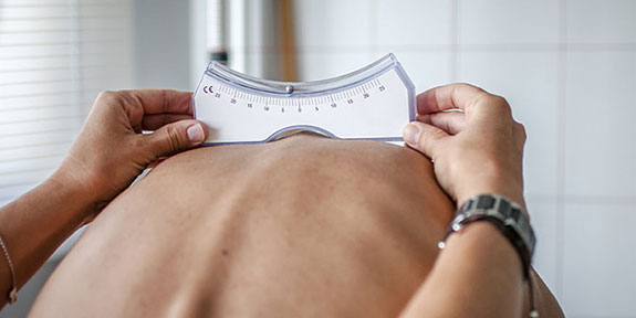 scoliosis Treatment in La Verne