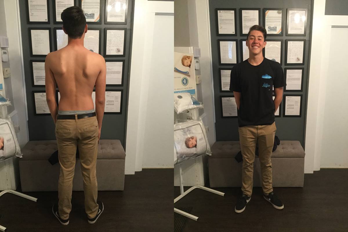 La Verne Scoliosis Chiropractic Treatment tips from La Verne chiropractor
