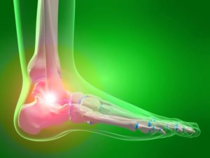 Read more about the article Plantar fasciitis